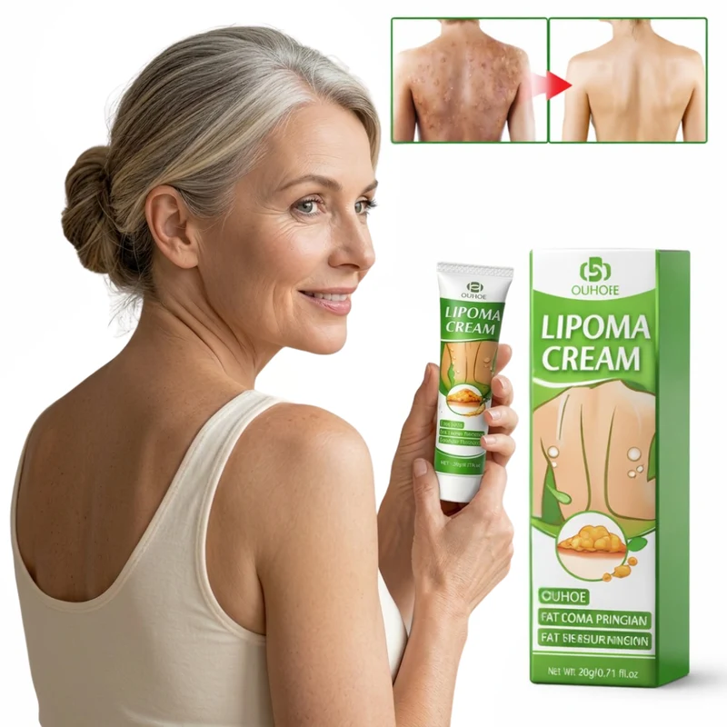 Lipoma Cream | Zichtbaar Kleinere Vetknobbels & Lipomen — Voel Verlichting Binnen Enkele Dagen