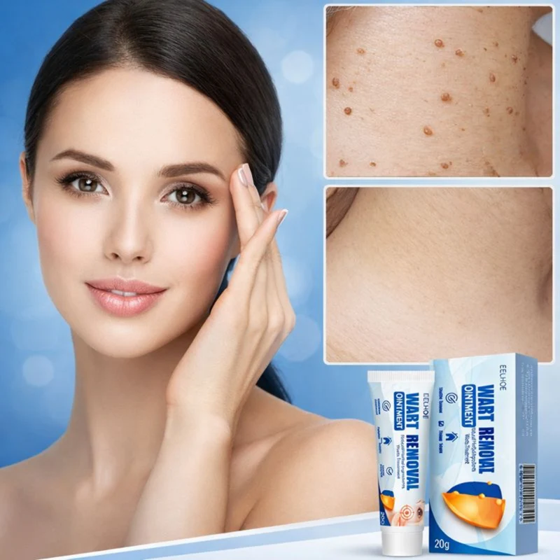 Eelhoe Wart Removal Ointment | Verwijdert Wratten & Skin Tags Snel — Zichtbare Resultaten Binnen Enkele Dagen