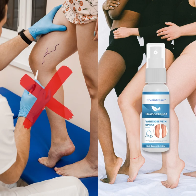 VeinErase™ Varicose Vein Spray