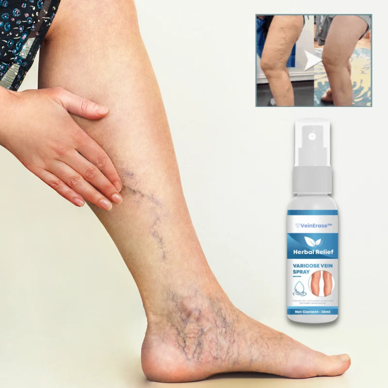 VeinErase™ Spray | Verwijdert 93% van de spataders in slechts 7 dagen!