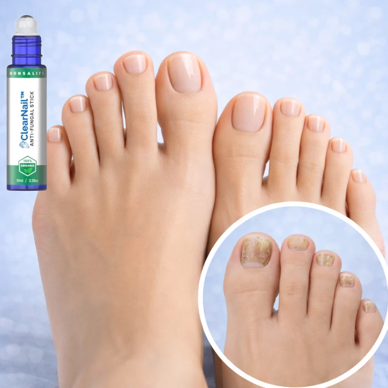 ClearNail™ | Weg met hardnekkige schimmelnagels in slechts 7 dagen!